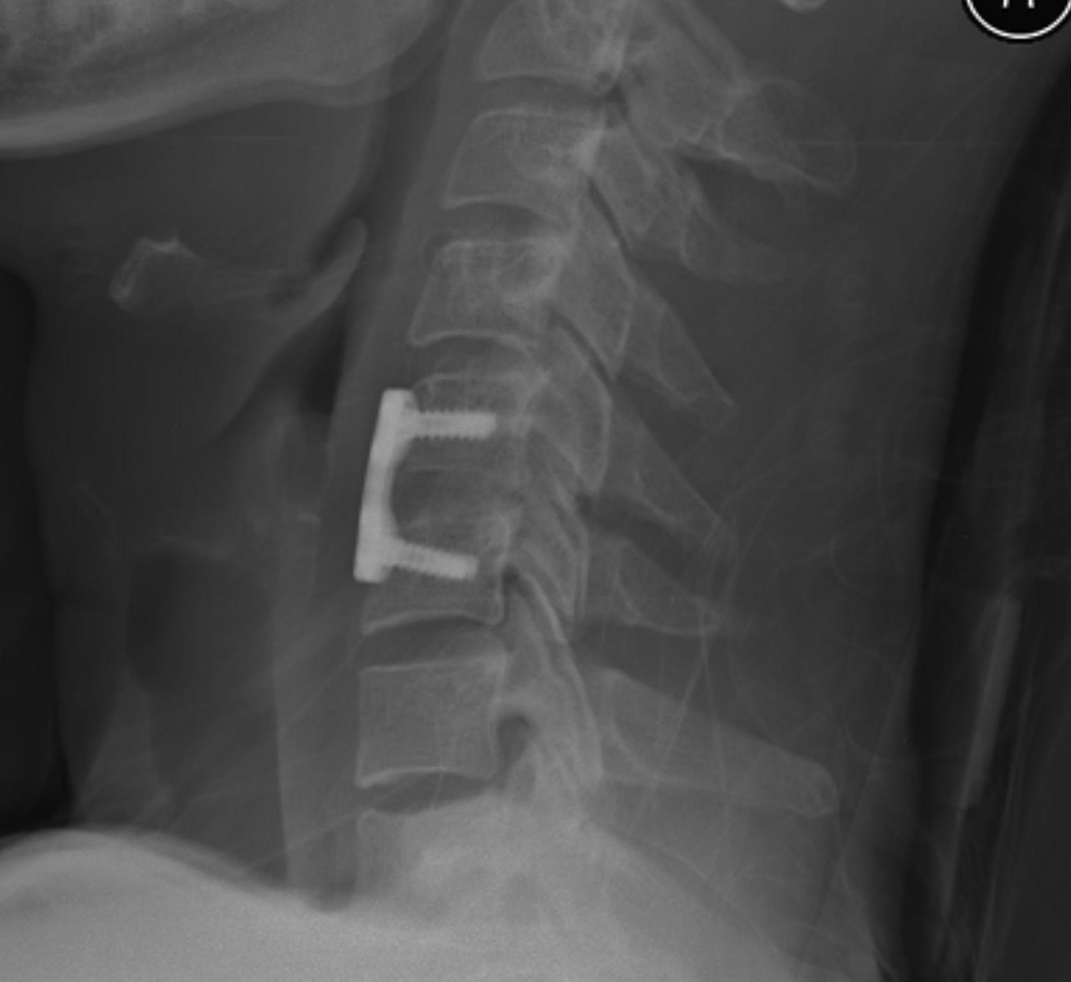 ACDF post C56 Unilateral Facet Dislocation